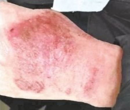 Foto tangan dokter yang memerah dan bengkak (Oriental Daily)